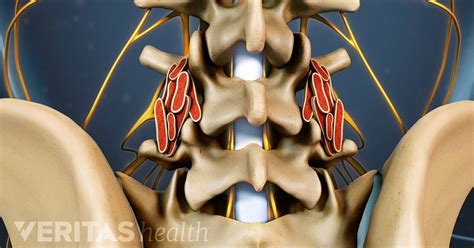 Controversies About Spinal Fusion Surgery Allografts Autografts And