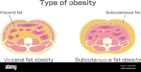 Type Of Obesity Illustration Abdominal Sectional View Visceral Fat Subcutaneous Fat Stock