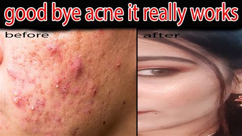 Clear Acne Scars Fastacne Problem Remedyjuhi Naaz Youtube