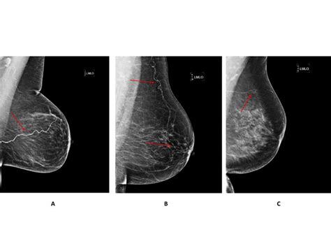 Mammograms May Help Predict Heart Disease Stroke Risk In Women After