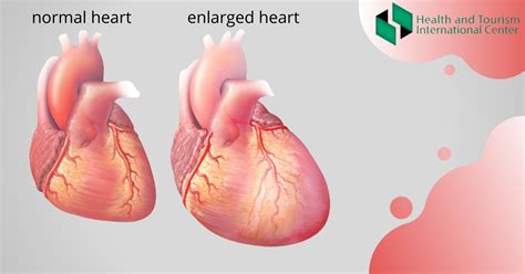 Cardiomegaly In What Cases Does The Heart Increase In Size Hti Centers Medical Tourism Center