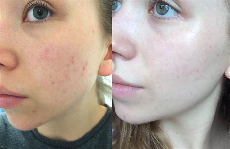 Acne Before And After Using Cliniques Even Better Clinical Dark