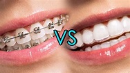 你看不到的優點？10個理由為何選擇隱形牙套｜快樂牙齒Happy Teeth TW