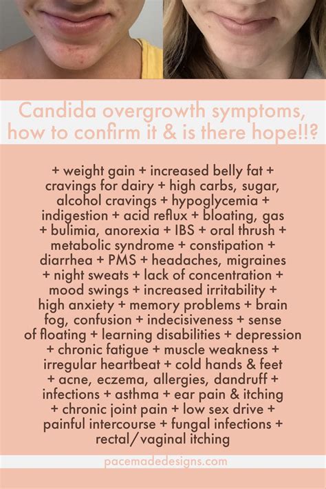 Candida Overgrowth Candida Diet Most Depressing Diet Ever — Rising