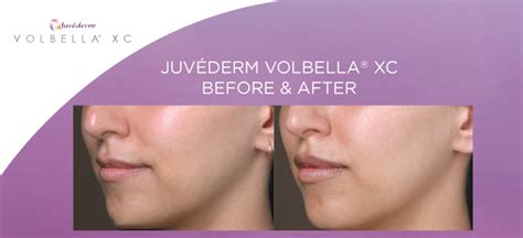 Juvederm Volbella Before And After Dermatólogo Contour Dermatólogos
