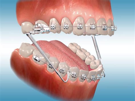 Orthodontic Appliances And Braces New Smile Orthodontics