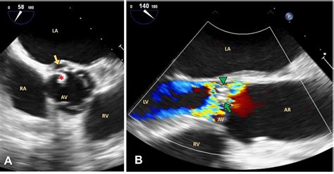 Triple Valve Infective Endocarditis A Case With Unusual Features