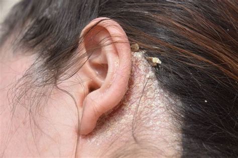 The Sneaky Things Causing Your Scalp To Itch And Flake Seborrheic