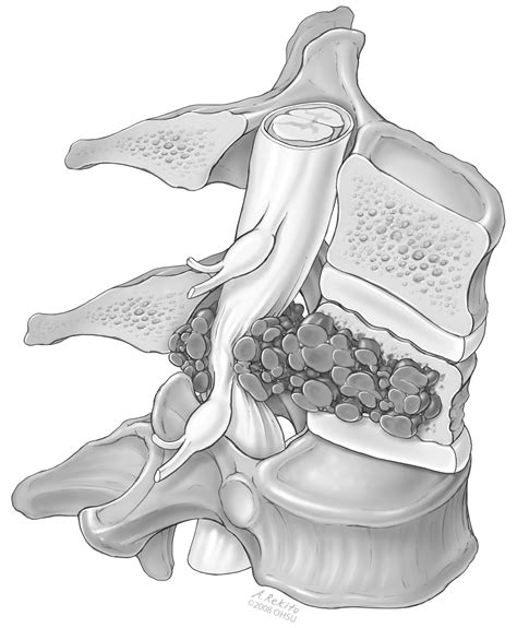 Thoracic Spinal Tumor On Behance