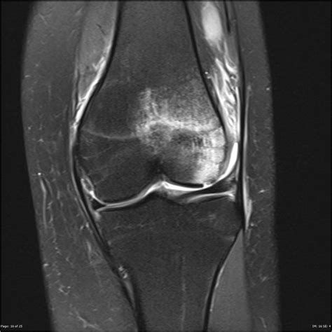 Osteochondral Fracture Lateral Femoral Condyle Image Radiopaedia Org