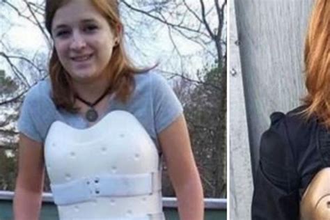 High Schooler Makes Her Back Brace Cool With Some Steampunk Flair Upworthy