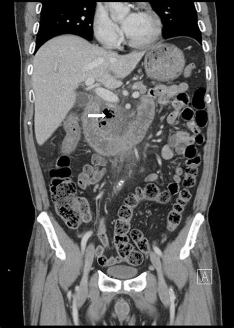 Abdominal Ct Showing Loculated Fluid Collection With Abundant Air