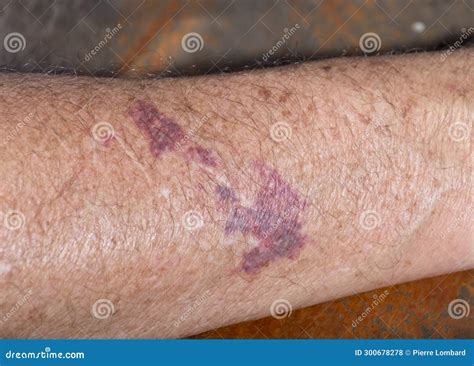 Close Up Of Bruise On Senior Man S Arm Stock Photo Image Of Medicine