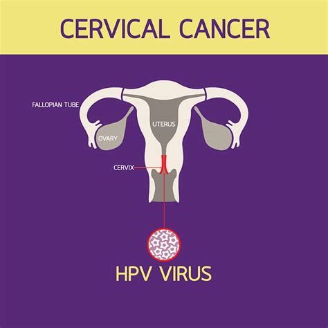 What Causes Cervical Cancer Christopher K Quinsey MD Obstetrics And Gynecology