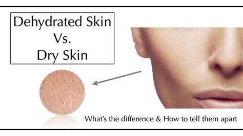 Dehydrated Skin Vs Dry Skin Skin Condition Vs Skin Type Youtube