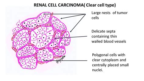 Renal Cell Carcinoma Clear Cell Type Pathology Made Simple