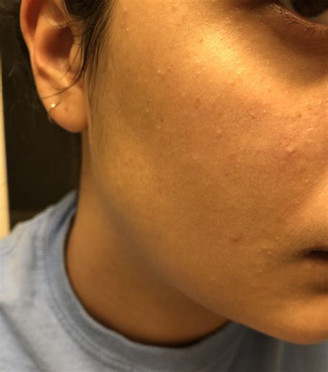 Skin Concern I Just Noticed All These Babe White Bumps On My Face