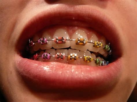 Jaki Kolor Gumek Do Aparatu Ortodontycznego Sobie Wziąść Zapytaj