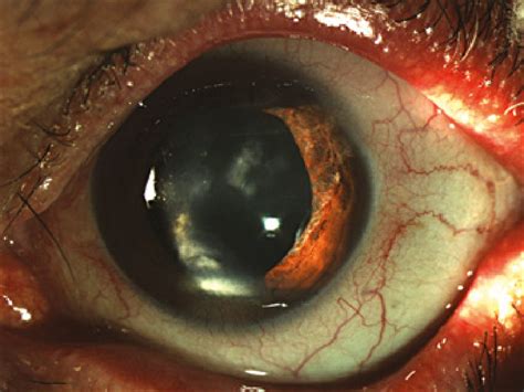 Iris Atrophy And Corneal Scarring In A Patient With Herpetic