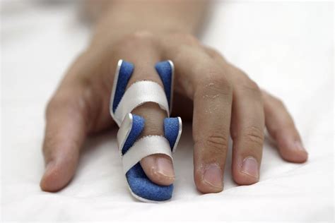 broken finger causes symptoms diagnosis and treatment