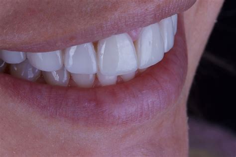 Treatment For Overlapping Teeth Birmingham Al
