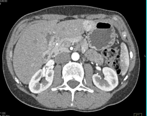 Focal Nodular Hyperplasia In Left Lobe Liver Case Studies Ctisus Ct