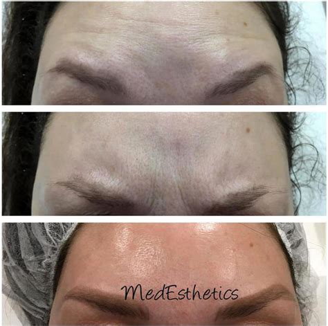 Safe Forehead Botox Before And After Facial Injections Info Prices