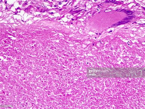 Caseous Necrosis Of Lymphatic Node40x Light Micrograph High Res Stock
