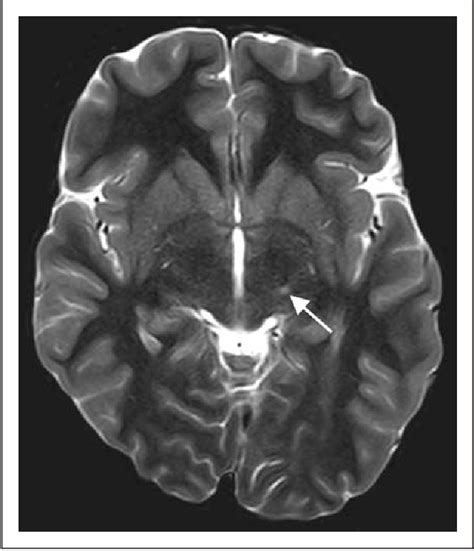 Mri White Matter Lesions In Pediatric Migraine Semantic Scholar