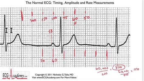 How To Calculate Heart Rate On Ekg Strip Haiper