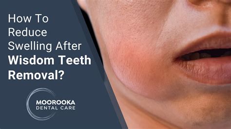 How To Reduce Swelling After Wisdom Tooth Extraction Tips For Wisdom