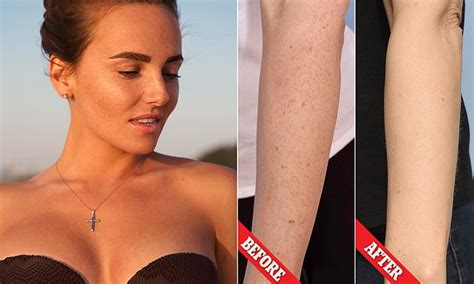 Cosmetic Surgeon Explains Why 690 Freckle Removal Treatments Are So Popular Daily Mail Online