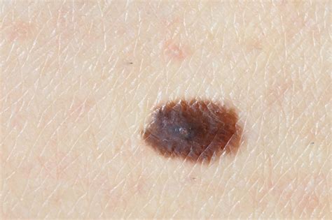 What Does Skin Cancer Look Like The Dermatology Center Of Indiana