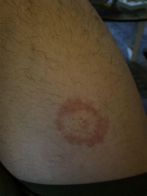 Ring Worm Lyme Disease Or Just A Circular Rash Dont Know How It