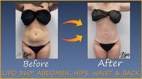 Lipo 360° Abdomen Hips Waist Back Immediate Results Awake Tumescent Liposuction Artlipo
