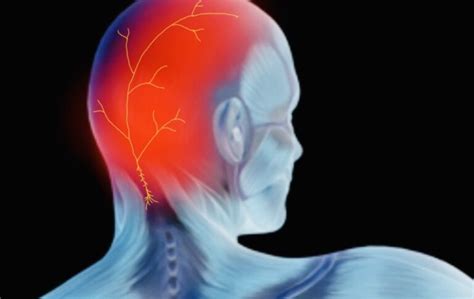What Triggers Occipital Neuralgia Common Triggers And How To Prevent Them