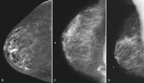 Mammogram Interpretation Radiology Key