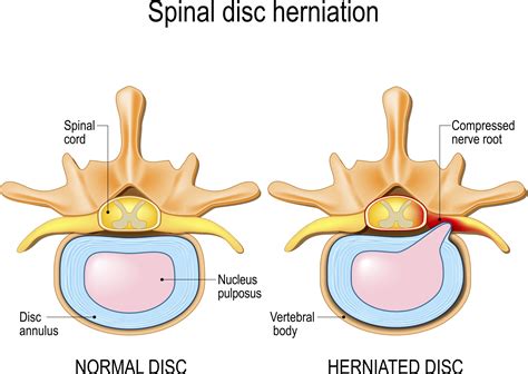 Herniated Disc In Neck Surgery Bulging Disc Vs Herniated Disc