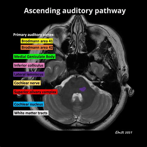 Ascending Auditory Pathway Annotated Mri Image