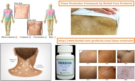 Natural Herbal Remedies For Tinea Versicolor Treatment Herbal Care