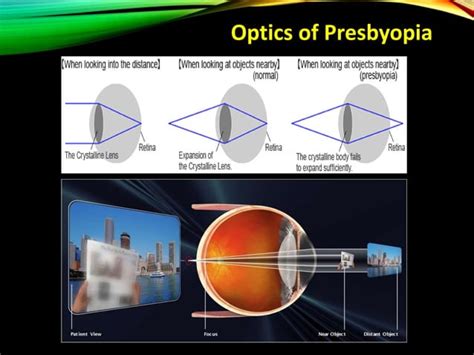 Presbyopia Methods Of Presbyopic Addition Determination