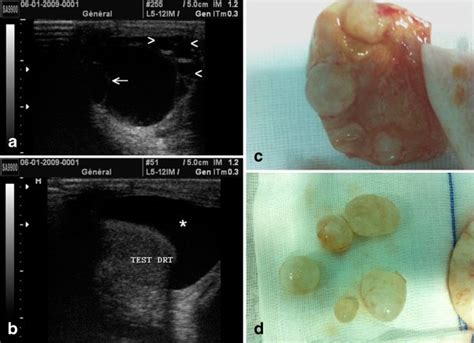 Unilateral Primitive Hydatid Cyst With Surgical Resection Of The Scrotum A Case Report