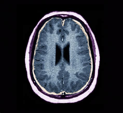 Bacterial Meningitis Mri Scan Photograph By Science Photo Library