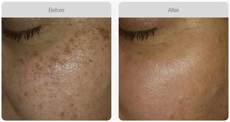 Ipl For Pigmentation Clear Skin Nascent Skin And Beauty Clinic