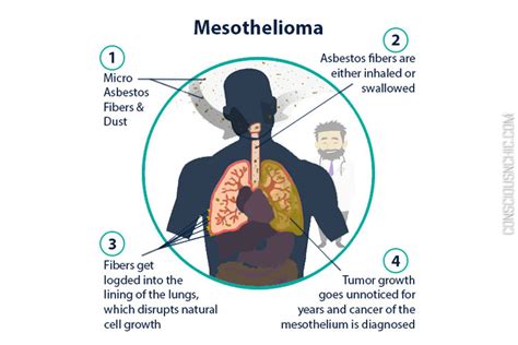 Mesothelioma Cancer Diagnosis Doctor Heck