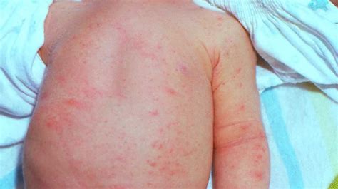 The Ultimate Guide To Identifying And Treating Viral Skin Rash In Children