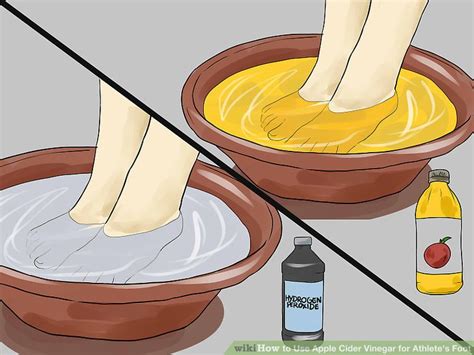 4 Ways To Use Apple Cider Vinegar For Athletes Foot Wikihow