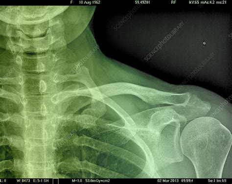Collarbone X Ray Stock Image C0231284 Science Photo Library