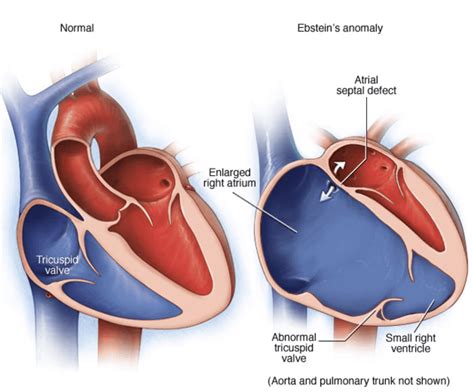 Ebsteins Malformation Cardio Guide