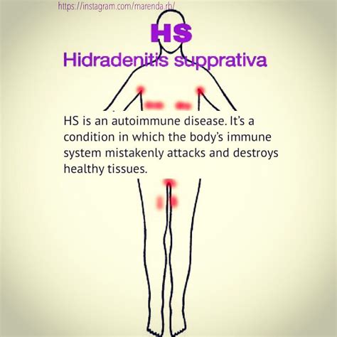 Hidradenitis Suppurativa Treatment